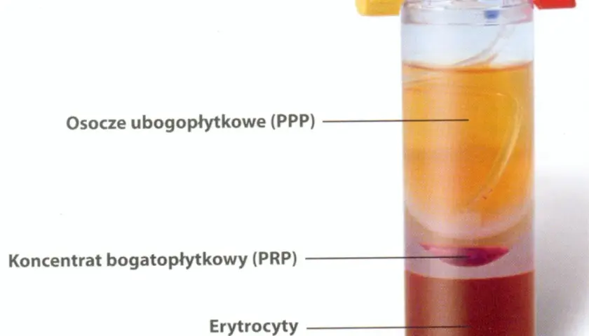 Probówka z rozwarstwionym osoczem: osocze ubogopłytkowe (PPP), koncentrat bogatopłytkowy (PRP) i erytrocyty.