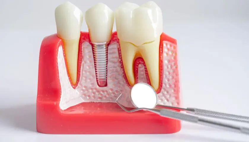 Modello dentale con impianto: anche con la piorrea si possono mettere i denti fissi. Strumenti dentistici in primo piano.