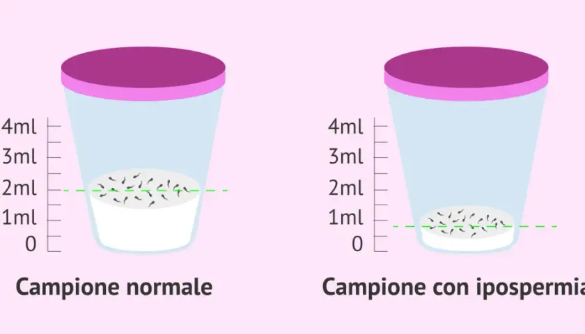 Confronto tra campione normale e ipospermia. La curiosità quando un uomo non viene, mostra una ridotta quantità di spermatozoi.