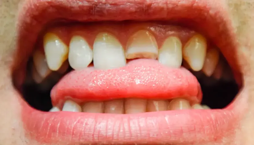 Primer plano de una boca abierta mostrando dientes delanteros con grietas visibles y una lengua rosada.