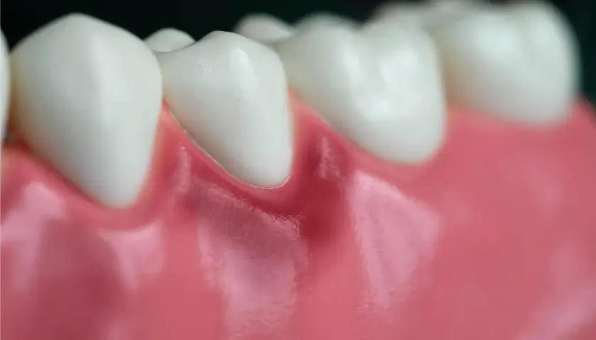 Detalle de dientes y encías, mostrando una leve inflamación en la encía de una muela.