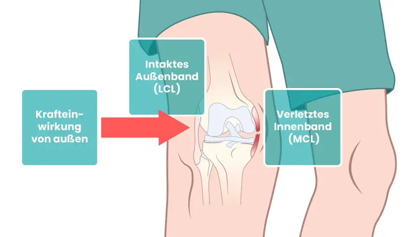 Schema zeigt Kniegelenk mit Kraftwirkung von außen, die zu einem verletzten Innenband (MCL) führt.