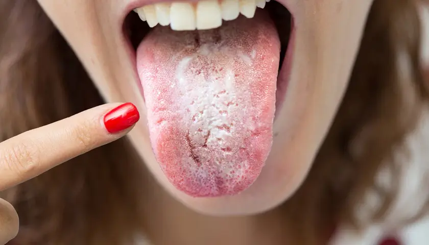 Una persona se señala la lengua, que se ve blanca y con una textura áspera y seca, indicando posible candidiasis oral.