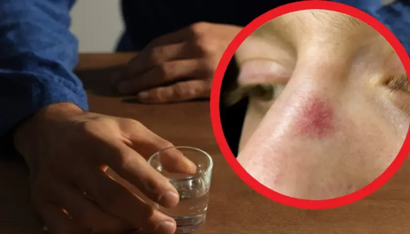 Dłoń sięga po kieliszek, a na policzku widoczne pajączki – objawy długotrwałego alkoholizmu.