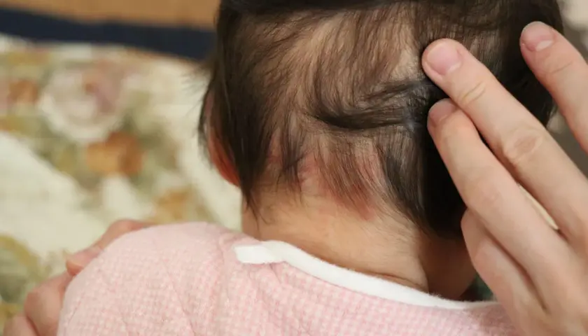 Piccolo bebè con macchie rosse sul collo, forse un morso della cicogna.