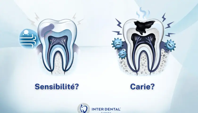 Dents saines vs. dent cariée. Si vous avez une sensibilité dentaire, que faire ? Consultez un dentiste.