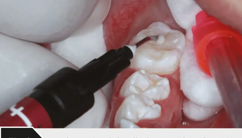 Aplicación de sellante dental en el molar 46. Un aplicador dental deposita el material en las fisuras del diente.