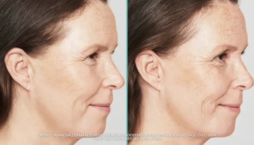 Porównanie skóry przed i po zabiegu skinbooster. Wygładzone zmarszczki, nawilżona i promienna cera.
