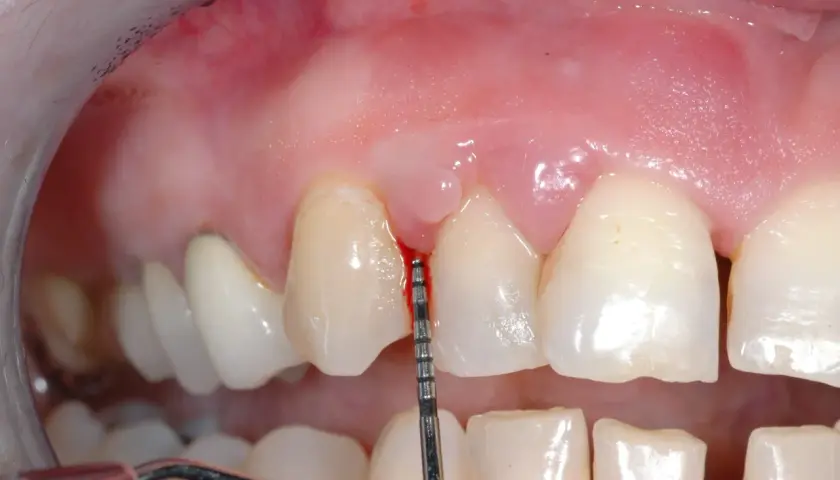 Strumento dentale misura la profondità gengivale. Alcuni credono che la pulizia dei denti rovina i denti, ma è fondamentale per la salute orale.