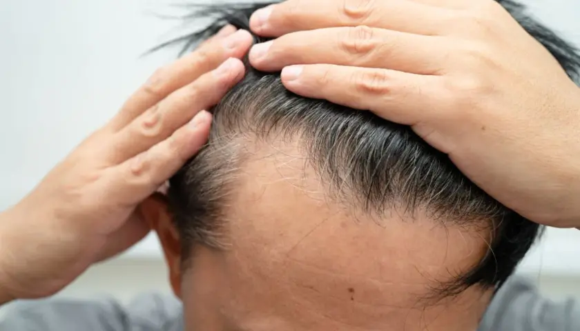 Man checking his hairline, concerned about thinning hair. This image can help you understand como saber si tengo alopecia.