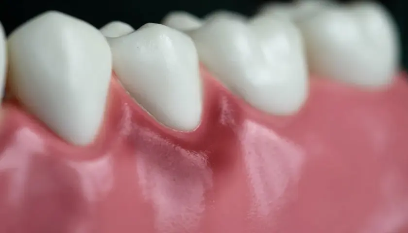 Detalle de dientes blancos y una encía roja en un diente, mostrando la línea de la encía.