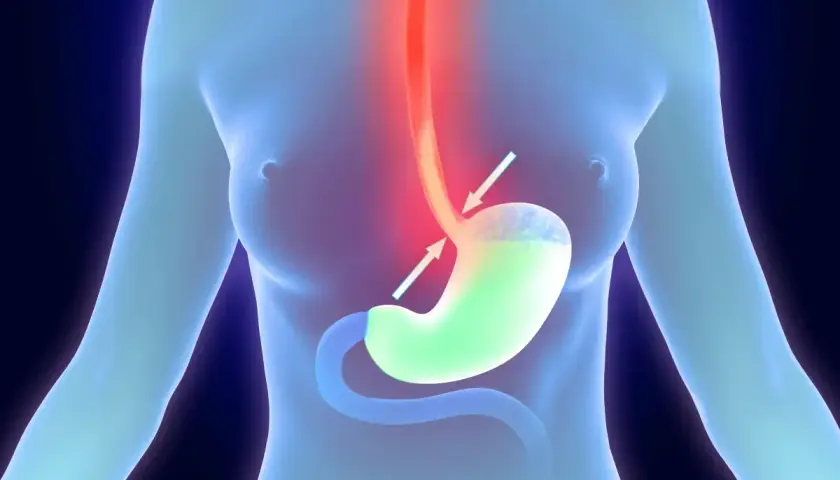 Illustrazione anatomica che mostra un esofago irritato e uno stomaco con reflusso, suggerendo ansia e strane sensazioni allo stomaco.