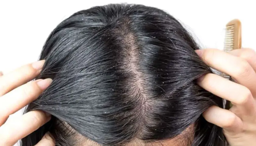 Cuoio capelluto con forfora visibile, sintomo comune della dermatite seborroica. Mani che separano i capelli scuri per mostrare le squame bianche.