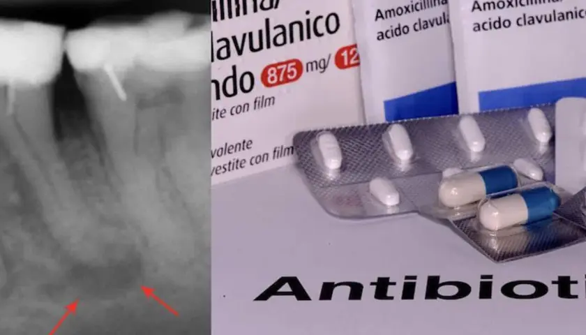 Radiografia di un ascesso dentale con confezioni di antibiotico amoxicillina/acido clavulanico.