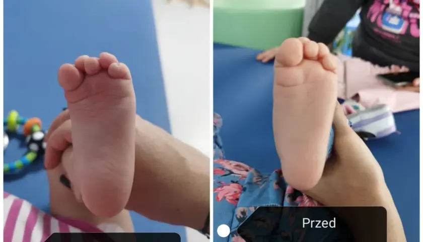 Dwa zdjęcia stopy dziecka: po lewej stopa sierpowata, po prawej ta sama stopa po terapii.