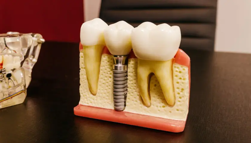 Model szczęki z zębami, gdzie jeden z nich zastąpiono przez mini implant ortodontyczny.