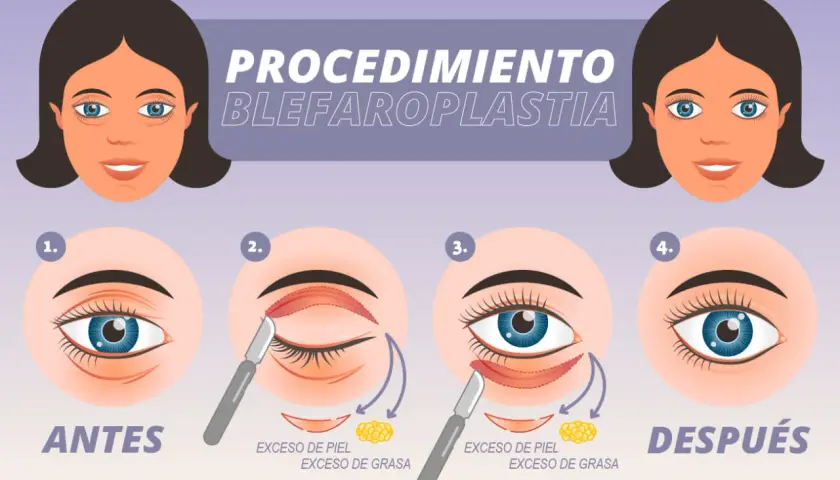 Ilustración del procedimiento de blefaroplastia para corregir párpados caídos, mostrando antes y después.