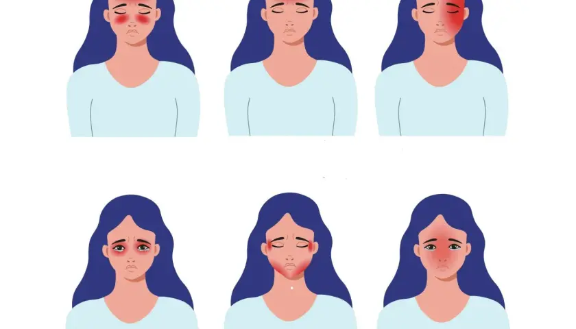 Ilustracje przedstawiają kobiety z różnymi objawami ciśnieniowego bólu głowy, odczuwając dyskomfort w okolicach czoła, skroni, oczu i szyi.