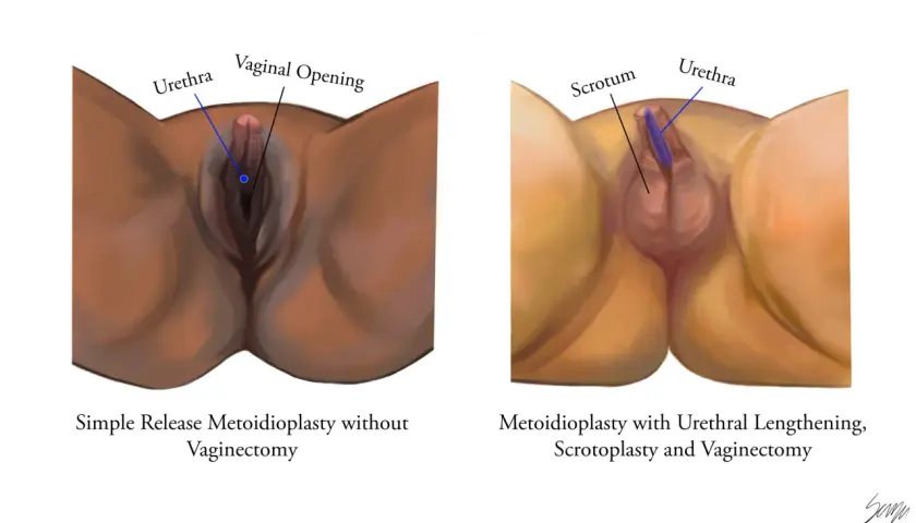 Comparaison de deux procédures chirurgicales pour transformer un pied mâle en femelle : la métoidioplastie simple et la métoidioplastie avec allongement urétral, scrotoplastie et vaginectomie.