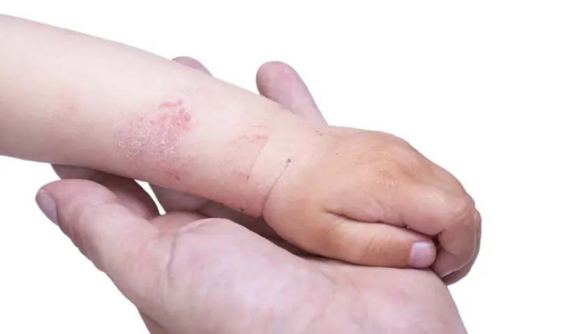 Mano di un adulto che tiene il braccio di un bambino con eczema. La pelle del bambino è arrossata e screpolata, mostrando i segni tipici dell'eczema nei bambini.