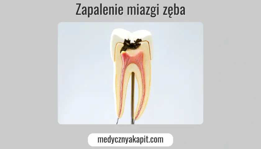 Przekrój zęba ukazujący próchnicę sięgającą do miazgi zęba, która jest zaczerwieniona i zaogniona.