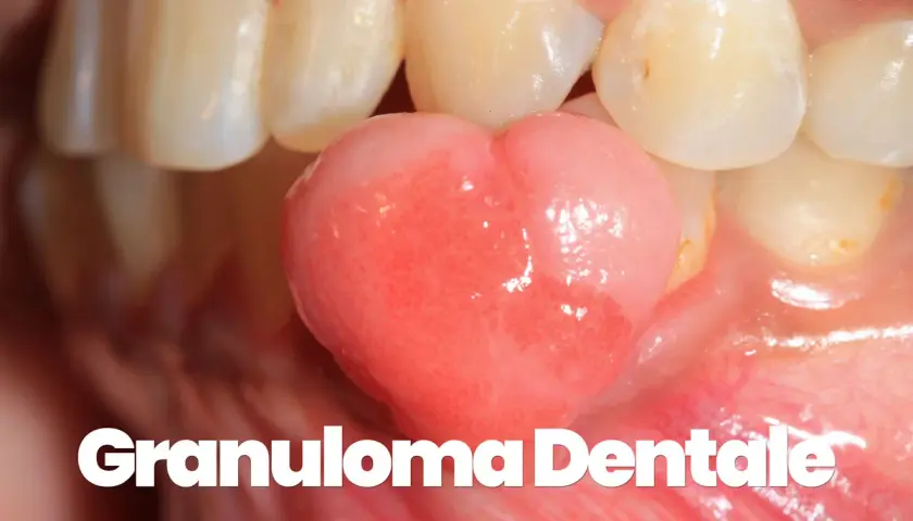 Un granuloma gengivale, una piccola protuberanza rosa, cresce tra i denti.