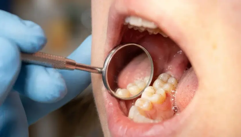Dentysta bada zęby, szukając próchnicy między zębami.