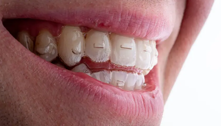 Uśmiech z przezroczystymi nakładkami Invisalign. Zastanawiasz się nad Invisalign cena? To dyskretne rozwiązanie dla prostych zębów.
