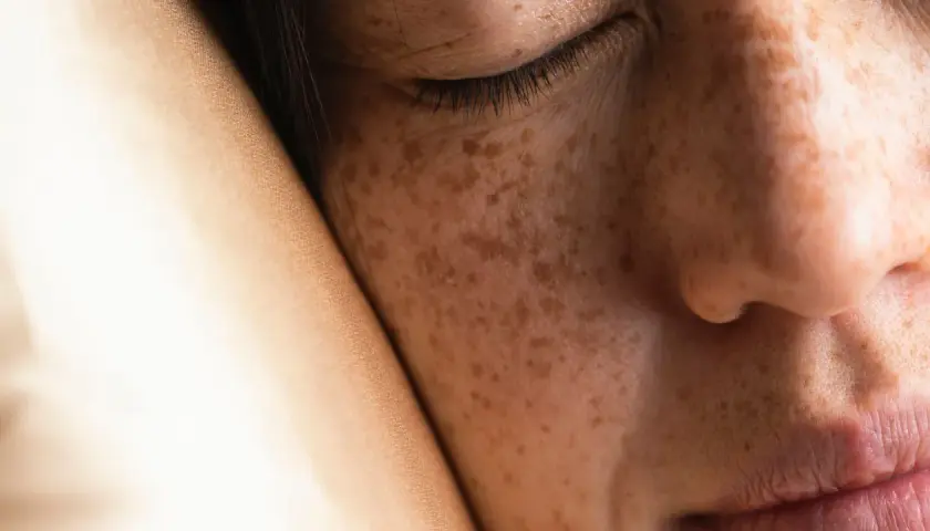 Primo piano del viso di una persona con lentiggini, con l'occhio chiuso e la guancia appoggiata su un tessuto. Si notano sottili rughe da cuscino.