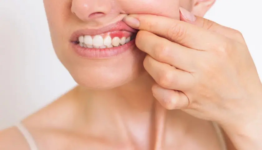 Donna mostra una gengiva gonfia e rossa, possibile conseguenza di una devitalizzazione dentale.