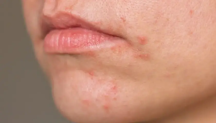 Haut um den Mund mit Rötungen und Pickelchen. Periorale dermatitis nulltherapie hilft nicht, die Haut ist gereizt.