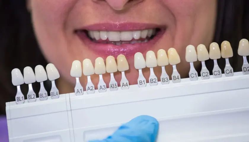 Selezione del colore per denti rifatti perfetti. Un sorriso smagliante inizia dalla scelta giusta.