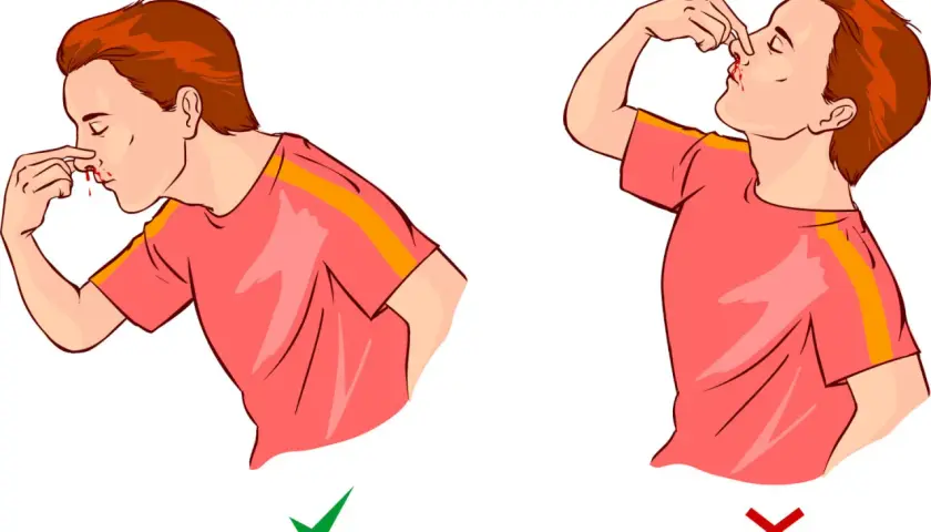 Ragazzo con sangue dal naso: la nonna insegna i rimedi. Sinistra: giusto, con la testa leggermente inclinata in avanti. Destra: sbagliato, con la testa all'indietro.