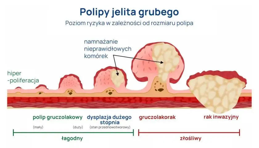 Rak jelita grubego: Czy badanie krwi wystarczy do diagnozy?