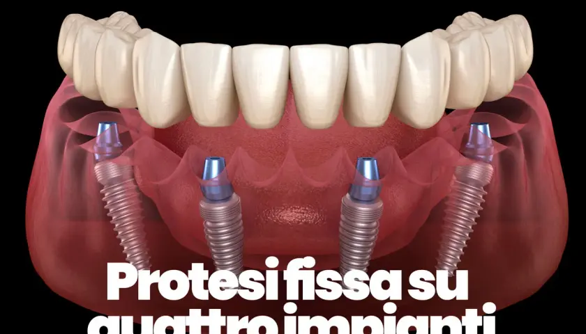 Protesi fissa su quattro impianti dentali, mostrando la struttura ossea e i pilastri che sostengono i denti.