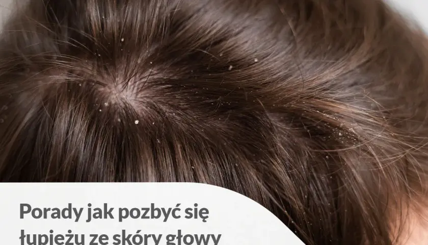 Widoczne białe płatki na ciemnych włosach wskazują na problem z łupieżem. Dowiedz się, jak pozbyć się łupieżu ze skóry głowy.