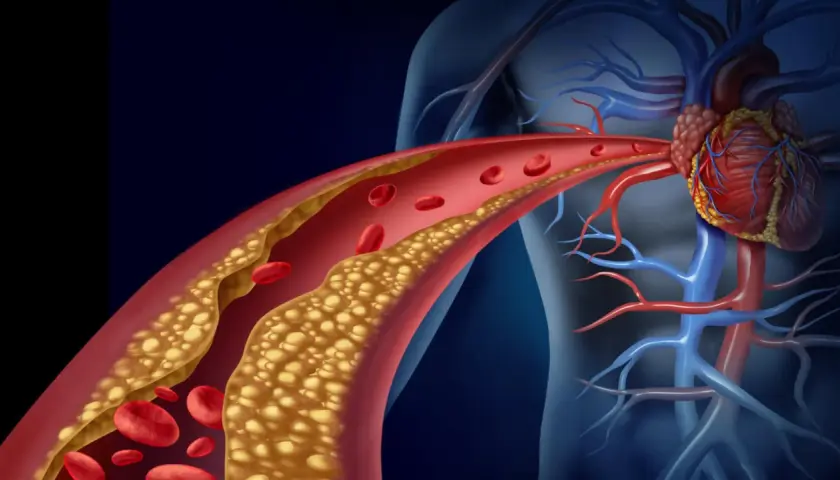 Zaburzenia lipidowe (dyslipidemia) to stan, gdy we krwi jest za dużo złego cholesterolu, co prowadzi do zwężenia naczyń krwionośnych i problemów z sercem.