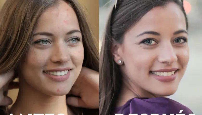 Antes y después de un tratamiento para el acné. La piel de la mujer luce más limpia y radiante, mostrando los beneficios de deripil.