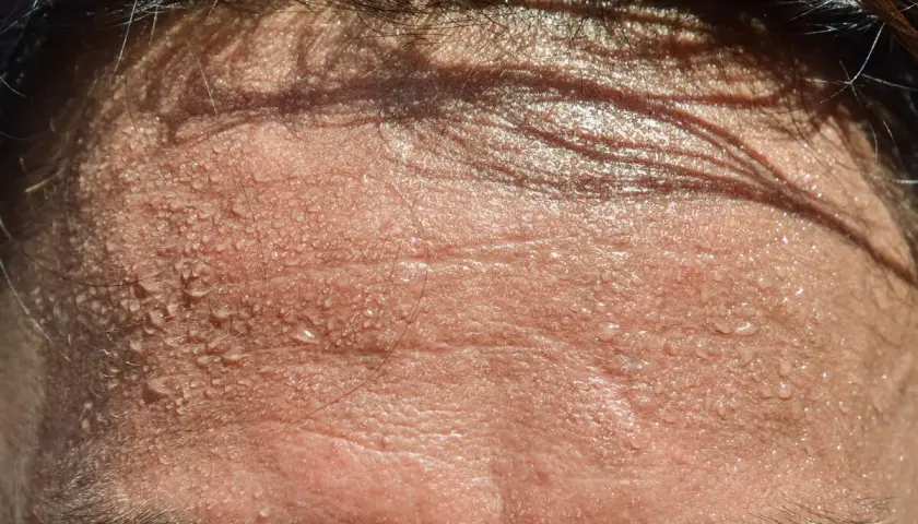 Frente sudorosa, con gotas de agua brillando. ¿Buscas trucos para no sudar por la cabeza?
