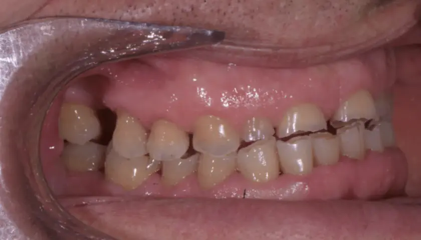 Denti con segni visibili di erosione dentale, con smalto consumato e bordi irregolari.