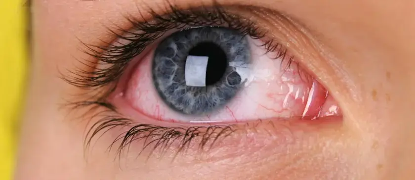 Occhio congiuntivite: arrossamento e secrezioni indicano possibili cause virali o batteriche.