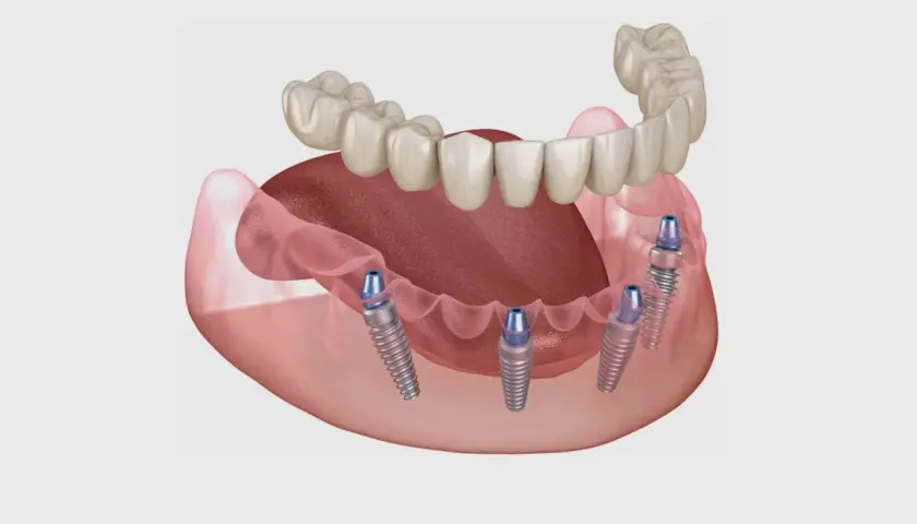 Immagine di protesi dentali fisse su impianti, una soluzione innovativa per chi cerca impianti dentali senza bucare osso.