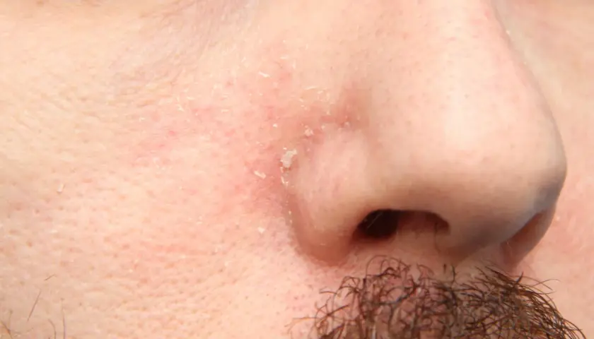 Piel enrojecida y escamosa alrededor de la nariz y la barba, indicativo de dermatitis seborreica barba.