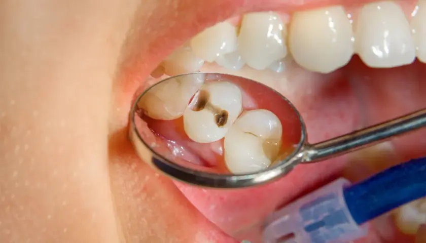 Specchio dentale riflette due denti con evidenti carie. Un dente ha una cavità scura, l'altro mostra un'area danneggiata.