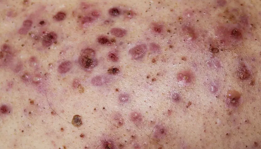 Piel con múltiples pápulas, pústulas y nódulos inflamados, característicos del acne conglobata.