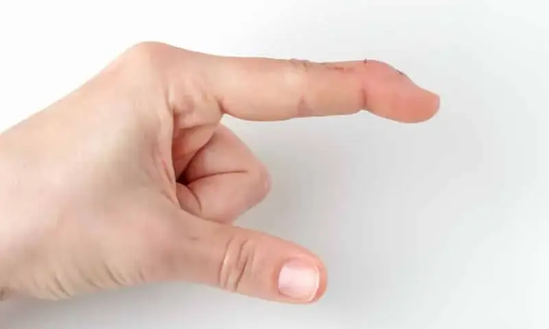 Krzywe palce u rąk na zdjęciach: objawy i typy deformacji
