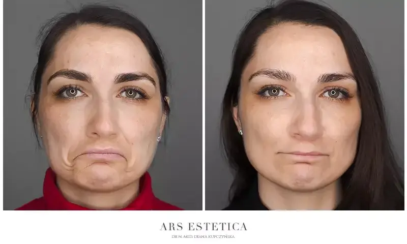 Botoks na czoło: Ile jednostek dla naturalnego efektu? Koszt