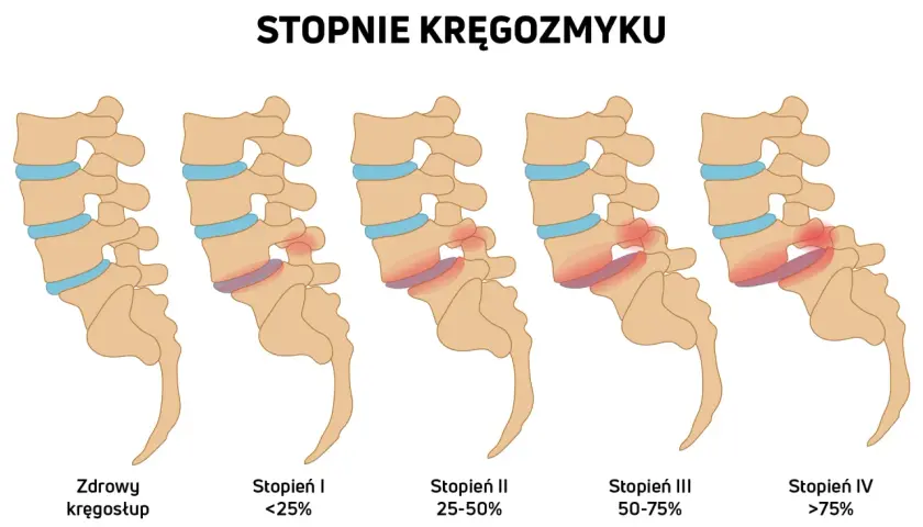 Ilustracja pokazuje stopnie kręgozmyku od zdrowego kręgosłupa do zaawansowanego kręgozmyku IV stopnia.
