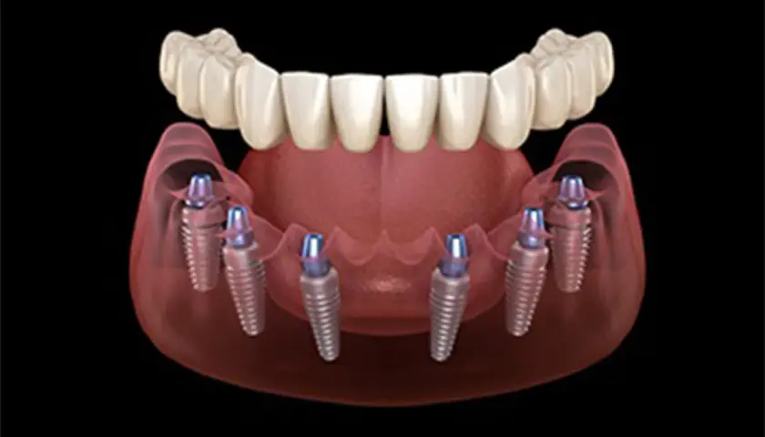 Modello 3D di un impianto dentale fisso con sei viti inserite nell'osso mascellare, pronte a sostenere una protesi dentale.