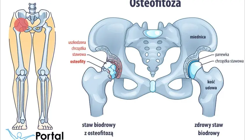 Osteofitoza: Jaka rehabilitacja? Odzyskaj sprawność i zwalcz ból!
